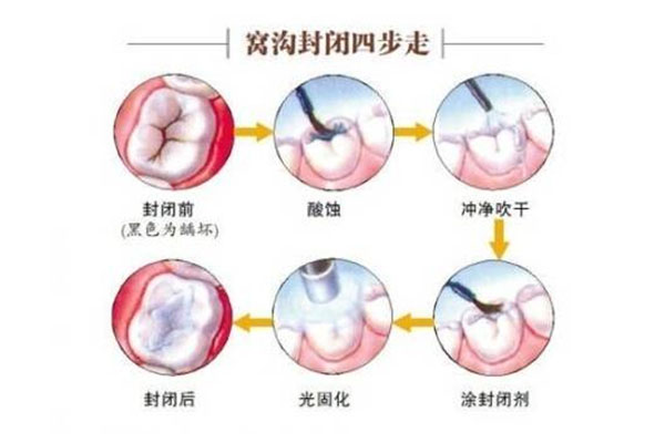 牙齿窝沟封闭几岁可以做(牙齿窝沟封闭几岁可以做手术)