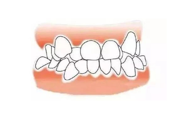 牙齿反颌治疗方法(牙齿反颌治疗方法有哪些)一文解释深入
