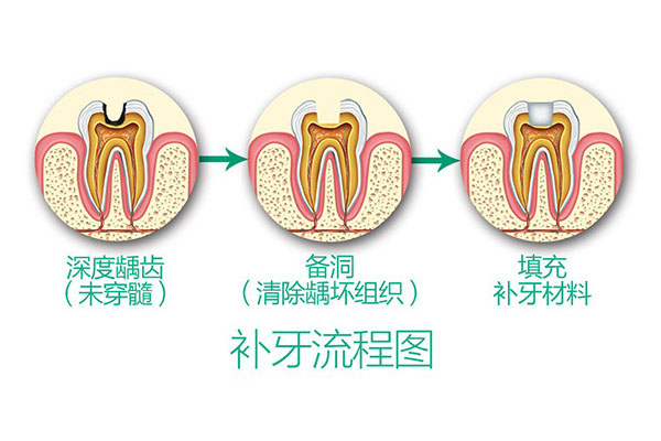 牙缝大用树脂补牙会对牙齿有什么伤害嘛(牙缝大用树脂补牙会对