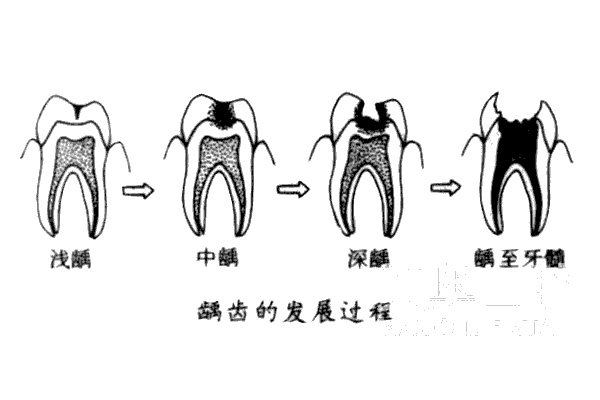 虫牙疼怎么办立刻止疼偏方(虫牙牙痛