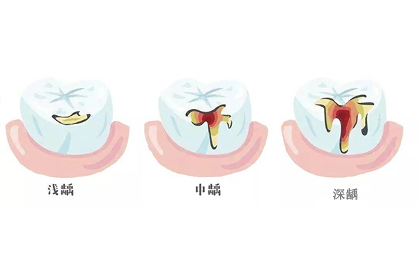 5岁孩子蛀牙疼怎么办(5岁孩子蛀牙疼