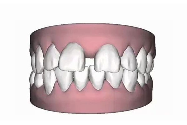 牙齿稀疏牙缝大怎么矫正40岁左右了呢(牙齿稀疏牙缝大怎么矫正40岁左右了呢视