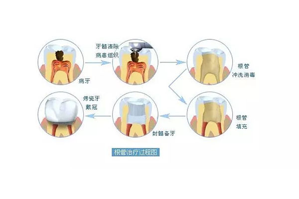 牙齿做根管治疗大概多长时间才能恢