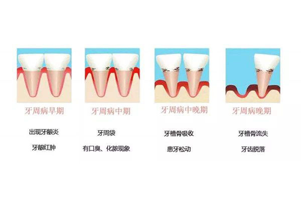 牙周病中医调理能治愈吗(牙周病中医调理能治愈吗多少钱)