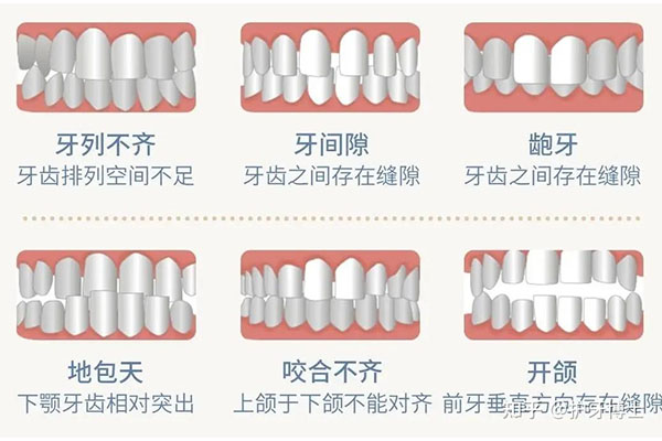 小儿牙齿不齐(小儿牙齿不齐怎样解决)一文探索深入