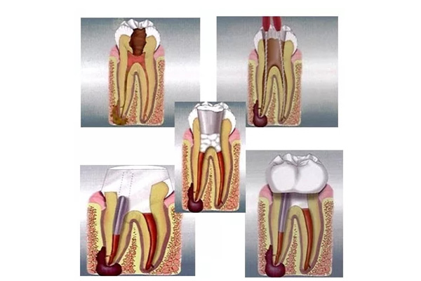根管治疗几年后牙又疼了(根管治疗几年后牙又疼了怎么回事)