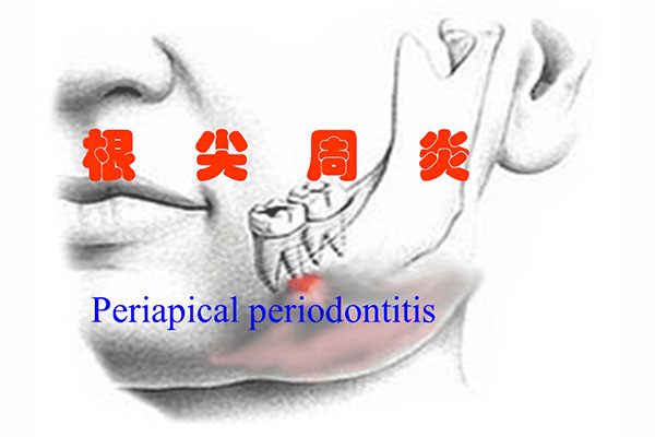 慢性牙根尖炎治疗多久会好(慢性牙根尖炎治疗多久会好啊)