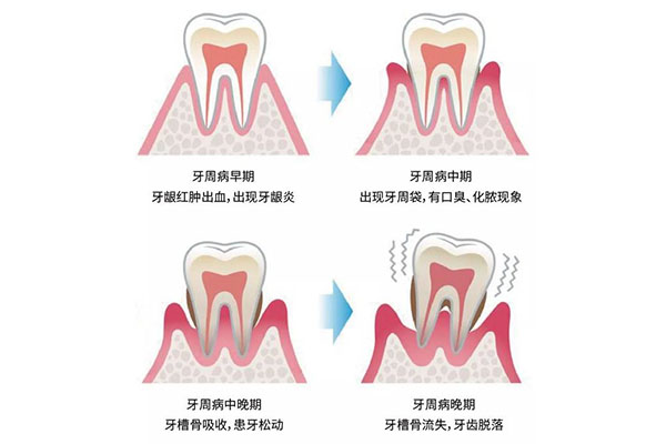 轻微牙周炎治疗多久(轻微牙周炎治疗多久会好)