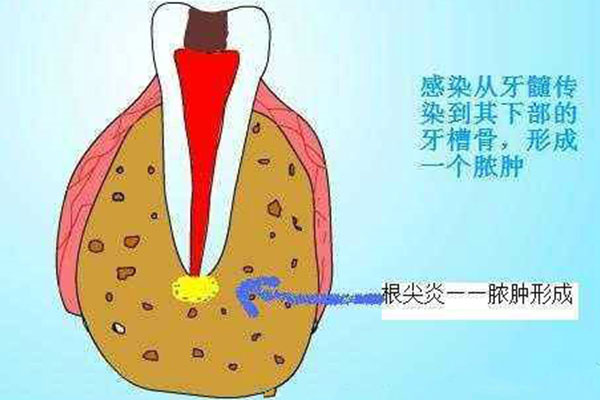 小孩牙根尖周炎治疗两次了还没消肿怎么办啊(小孩牙根尖周炎治疗两次了还没