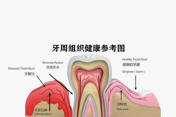 中度牙周炎能控制住吗能治好吗(中度牙周炎能控制住吗能治好吗图片)