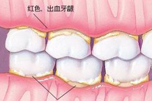 吃东西牙龈容易出血(吃东西牙龈容易出血怎么回事)