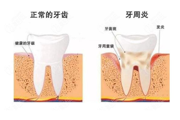 牙周炎的药水(牙周炎的药水用两次有效果吗)