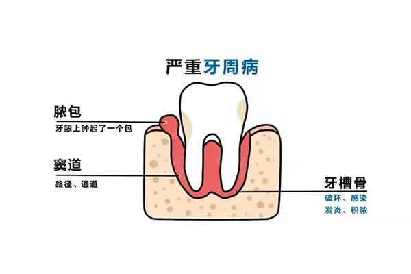 牙周炎口臭是什么原因导致的呢(牙周炎口臭是什么原因导致的呢怎么治疗)