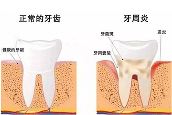 严重牙周炎有危害吗怎么治疗呢(严重牙周炎有危害吗怎么治疗呢视频)