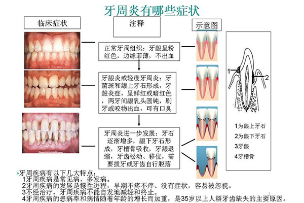 治疗牙周炎的牙膏有哪些品牌(治疗牙周炎的牙膏哪个好)