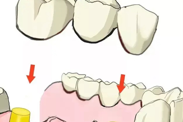 全瓷牙连冠最多几颗(全瓷牙连冠最多几颗牙齿)