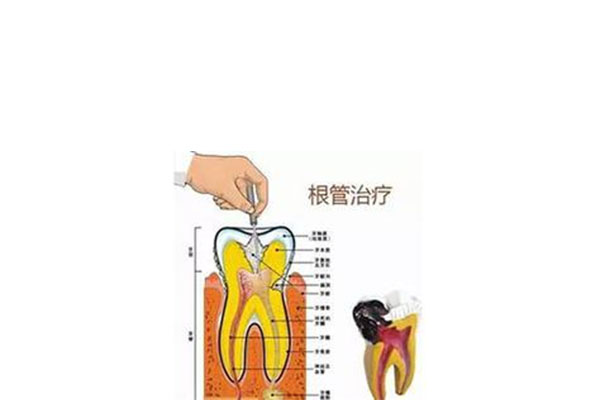 牙疼怎么根管治疗(牙疼怎么根管治疗最好)