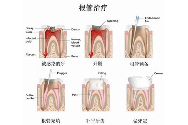 做完根管炎症多久会消(做完根管炎症没消怎么办)