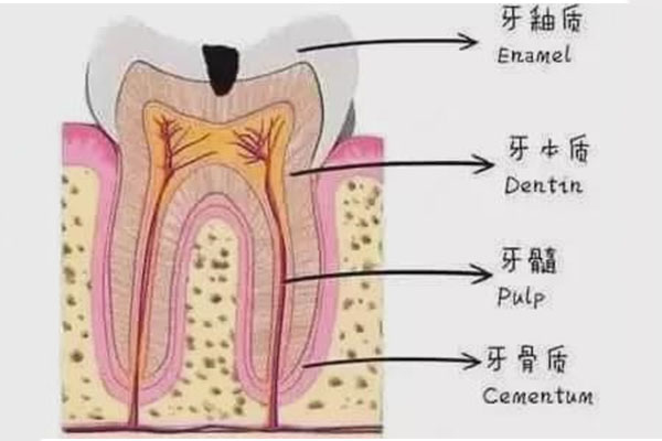 根尖炎急性发作开髓引流没用了(根尖炎急性发作开髓引流没用了吗)