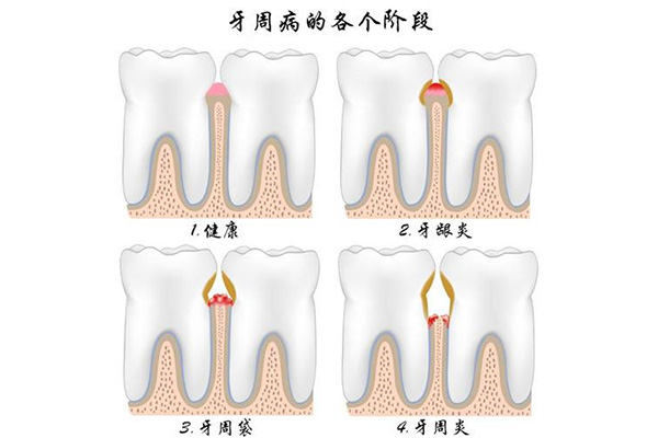 牙周刮治比洗牙疼多少倍正常呢(牙周刮治比洗牙疼多少倍正常呢