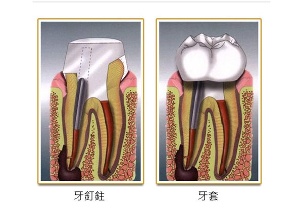 根尖周炎可以吃牛黄解毒片吗(根尖周炎吃牛黄甲硝唑几天有效)