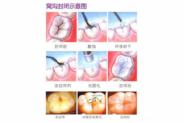 窝沟封闭应用于什么牙齿(窝沟封闭应用于什么牙齿)