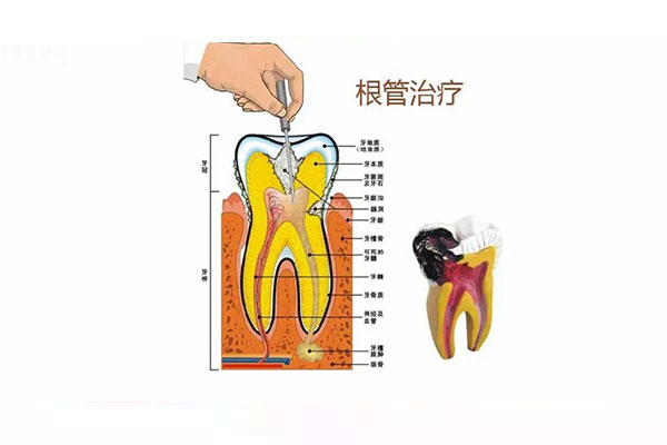 根管治疗一颗牙需要多少钱费用(根管治疗一颗牙需要多少钱?)