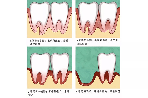 糖尿病患者牙周炎的诊治原则(糖尿病患者牙周炎的诊治原则是什么)