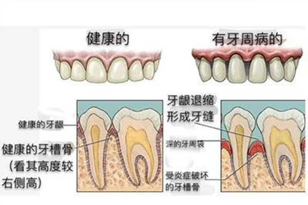 慢性牙周炎的典型症状是什么(慢性牙周炎的典型症状是什么意思)