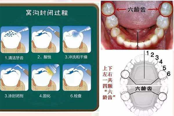 口腔医院 涂氟(口腔医院涂氟挂什么科)