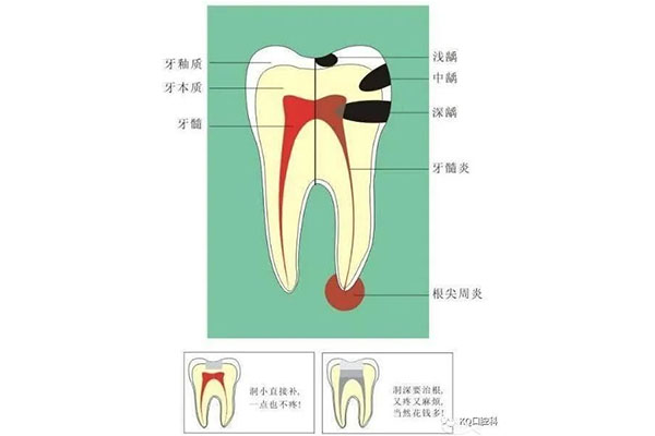 根尖炎引起发烧吃什么药最好(根尖炎引起发烧吃什么药最好使)