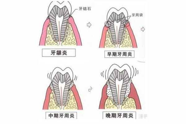 牙周炎怎么自愈中医调理好(牙周炎中医怎么治疗最有效)