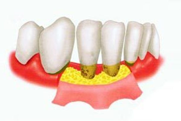 牙龈萎缩是牙周炎还是牙龈炎引起的原因(牙龈萎缩是牙周炎吗