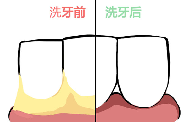 儿童牙齿上有黄色的斑块怎么去掉(儿童牙齿上有黄色的斑块怎么