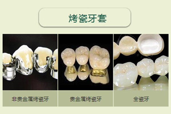 烤瓷牙套掉下来了还能用吗多少钱(烤瓷牙套掉下来了还能用吗多