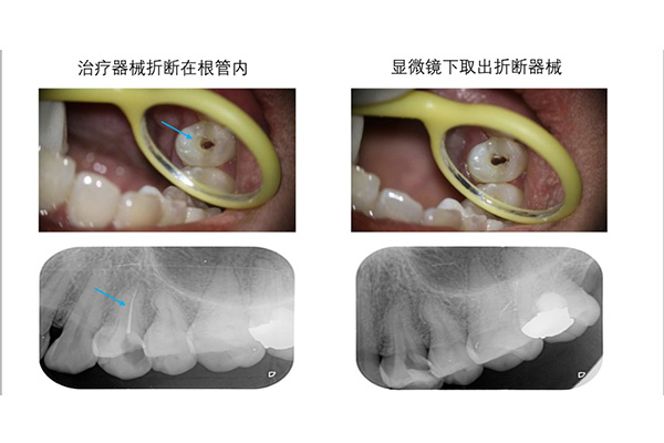 牙髓炎一定要做根管治疗(牙髓炎一定要做根管治疗吗?有问题就