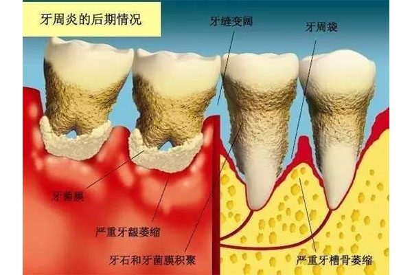 老年性牙龈萎缩多大年龄出现正常现象(老年性牙龈萎缩怎么办