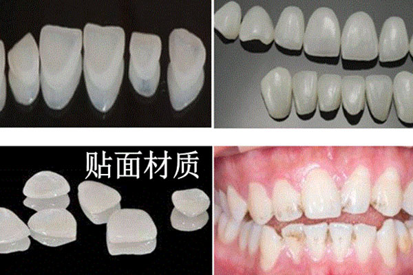 口腔医院贴面价位(口腔医院贴面价位多少钱)