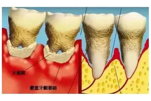 牙龈萎缩刷不干净怎么回事(牙龈萎缩