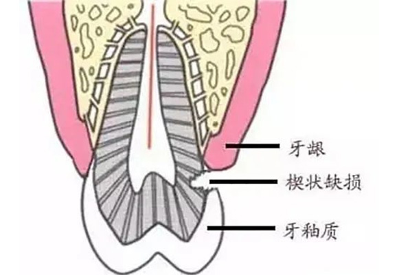 牙槽骨缺损怎么办(牙槽骨缺损怎么办