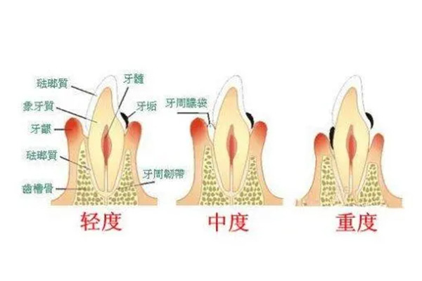 糖尿病 牙周病(糖尿病牙周病变)