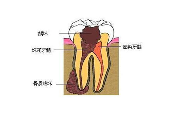 虫牙早期可以通过勤刷牙解决吗为什么(虫牙早期可以通过勤刷牙