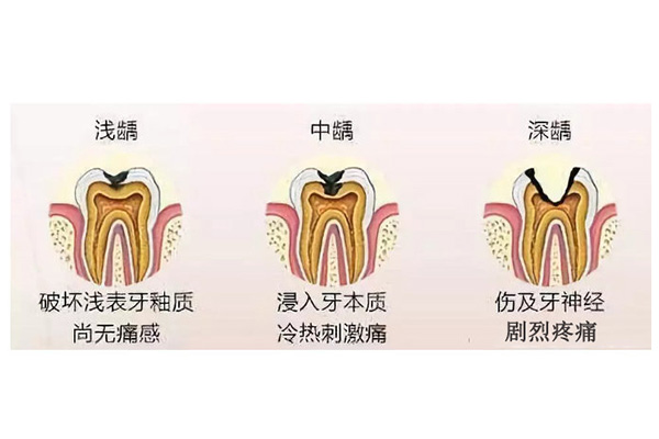 蛀牙怎么能不疼(蛀牙怎么才能不痛)