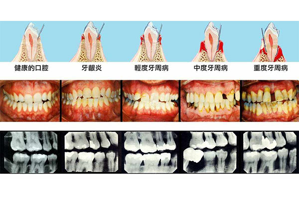 严重牙周病怎么治疗效果好些(严重牙周病的治疗方法)