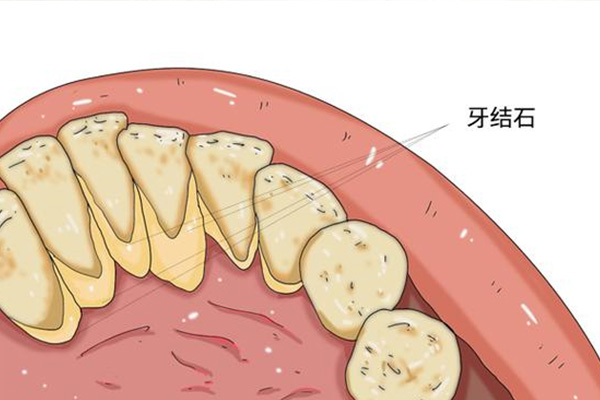去除牙黄牙结石小妙招(去除牙黄牙结石小妙招图片)