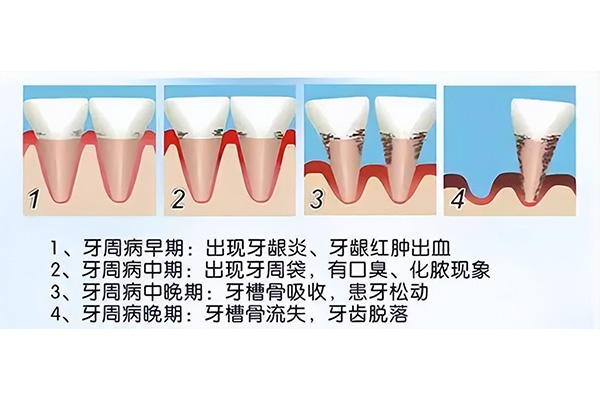 孩子得了牙周炎怎么治疗好(孩子得了牙周炎怎么治疗好的快)