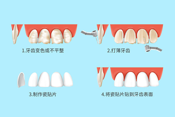 一颗牙齿全瓷贴面价格(一颗全瓷贴面牙齿成本多少钱)