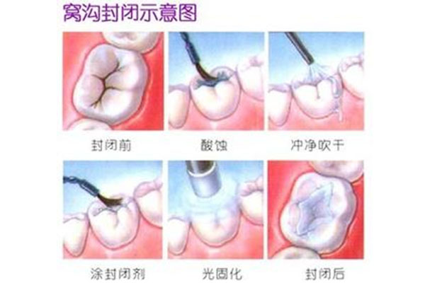 小孩牙涂氟多少钱一次(小孩牙涂氟多少钱一次图片)