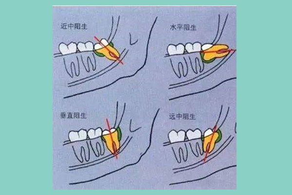 智齿是不是小小的一个(智齿是不是小小的一个牙齿)