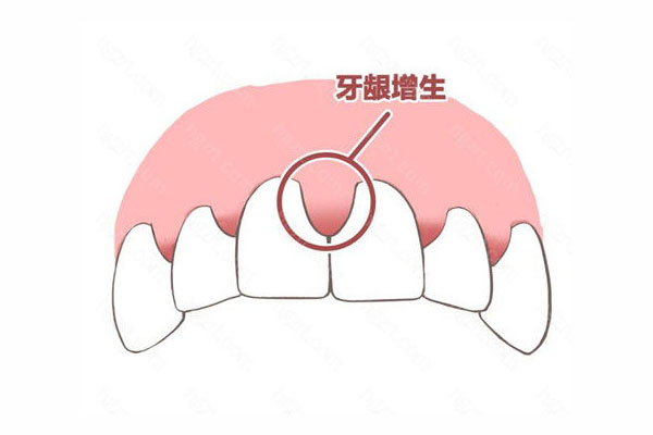 刷牙姿势不对牙龈萎缩了